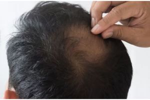 Kurang dari 2 minggu, ini cara atasi kebotakan koin hanya pakai hair serum dari 1 jenis kulit buah