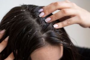 Bukan dengan gula pasir, begini trik eksfoliasi kulit kepala agar bebas ketombe pakai 2 jenis minyak