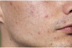 Hasilnya terlihat kurang dari seminggu, ini trik atasi jerawat dan bekasnya pakai 2 bahan rempah