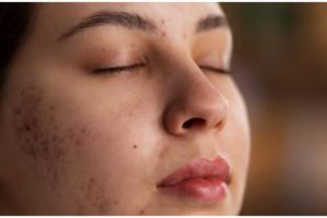 Tanpa masker kunyit, ini cara cerahkan flek hitam di wajah akibat sinar matahari pakai 1 jenis daun