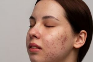 Tak kalah efektif dari oatmeal, ini cara menghilangkan jerawat dan bekasnya pakai 1 jenis buah