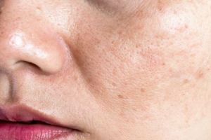 Tanpa putih telur, begini cara mengatasi flek hitam dan keriput wajah pakai 1 jenis tepung