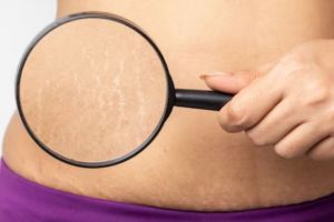 Bukan dengan kentang, begini trik pudarkan stretch mark pakai scrub dari 1 jenis bahan pemanis