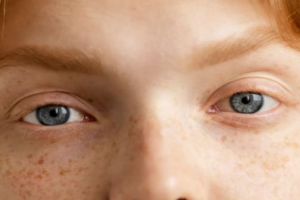 Tak pakai lemon, begini trik hilangkan flek hitam akibat sinar matahari dengan 1 jenis minyak esensial