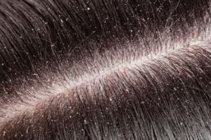 Nggak perlu minyak zaitun, ini cara hempas ketombe dan residu kulit kepala dengan 1 jenis biji-bijian