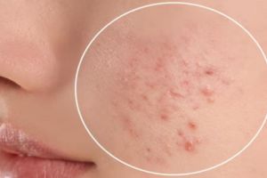 Bukan dengan serum vitamin C, ini trik sembuhkan jerawat meradang pakai 1 jenis minyak esensial