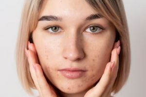 Tak perlu tambahan kunyit, ini cara hempas flek dan noda hitam pada wajah pakai 2 jenis bahan minuman