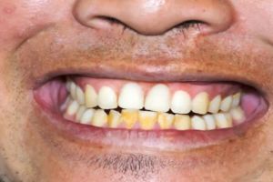 Tanpa lemon dan garam, ini trik memutihkan gigi kuning dan mengatasi bau mulut pakai 1 jenis minyak