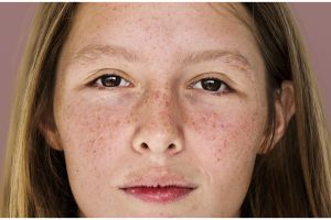 Tanpa serum vitamin C, ini cara menghilangkan flek hitam pada remaja hanya pakai 1 bahan makanan