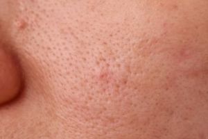 Bukan dengan scrub kopi, begini trik kecilkan ukuran pori-pori wajah pakai 1 jenis bahan pemanis