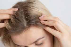 Tak kalah ampuh dari aloe vera, ini cara atasi kulit kepala kering berkerak pakai 1 jenis olahan susu