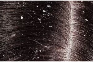 Bukan dengan lidah buaya, ini trik mudah merontokkan ketombe berkerak hanya pakai 1 jenis minuman