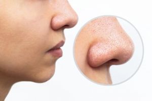 Tak perlu porepack, ini trik angkat komedo wajah tanpa rasa sakit pakai 1 jenis produk fermentasi