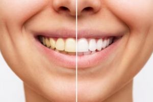 Bukan dengan cengkeh dan baking soda, begini trik putihkan gigi yang menguning pakai 1 jenis rempah
