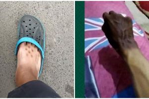 11 Potret kocak kulit belang karena panas-panasan ini bikin nyesel nggak pakai sunblock ke luar rumah