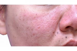 Tanpa kunyit, ini cara rapatkan pori-pori agar kulit tak cepat berminyak pakai toner dari 2 jenis buah