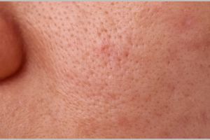 Bukan dengan garam, ini cara menghaluskan tekstur kulit akibat pori-pori besar pakai 1 jenis lalapan