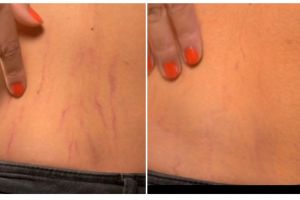 Bukan pakai minyak zaitun, begini cara menyamarkan tampilan stretch mark dengan 1 jenis sumber protein