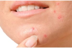 Bukan dengan lemon, ini trik atasi jerawat membandel di wajah hanya pakai 1 bahan alami