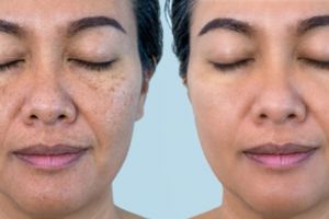 Tak perlu madu, ini trik hempas flek hitam membandel di wajah pakai 1 jenis tepung