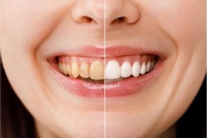 Tak perlu lemon, ini trik bikin gigi lebih kuat dan putih pakai kulit 1 sumber protein
