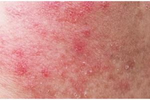 Tanpa gunakan baking soda, ini cara mudah pudarkan noda hitam akibat bekas jerawat pakai 2 bahan alami