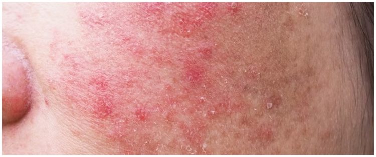 Tanpa gunakan baking soda, ini cara mudah pudarkan noda hitam akibat
