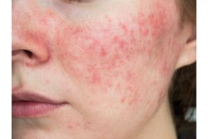 Tak hanya aloe vera, ini cara atasi kulit kemerahan akibat iritasi pakai tambahan 1 jenis lalapan
