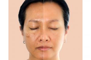 Tanpa gel aloe vera, ini trik cerahkan kulit kusam dan noda pigmentasi pakai 1 jenis bunga