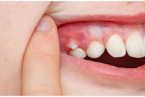 Aksi wanita tunjukkan cara membuat gigi gingsul buatan sendiri, hasilnya tampak natural