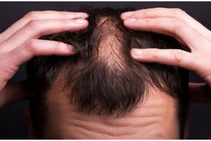 Tanpa bawang bombay, ini cara atasi rambut pitak agar kembali tumbuh lebat pakai 1 jenis biji-bijian