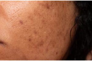 Tanpa laser wajah, ini cara mudah pudarkan flek hitam agar kulit kembali cerah pakai 1 bumbu dapur