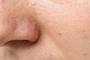 Tanpa baking soda dan kopi, ini trik mengecilkan pori-pori wajah pakai 1 jenis bahan makanan