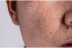 Tak perlu lemon, ini cara mencerahkan noda hitam di wajah agar kembali glowing pakai 1 bumbu rempah