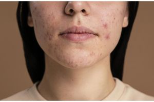 Bukan hanya kunyit, ini trik mudah mencerahkan noda hitam di wajah pakai pembersih dari 1 jenis sayur