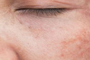 Bukan pakai kopi dan oatmeal, ini trik atasi flek hiperpigmentasi wajah dengan 1 jenis buah-buahan