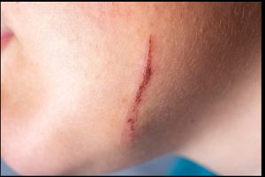 Tak perlu cuka sari apel, ini cara mudah hilangkan bekas luka di wajah hanya pakai 1 jenis biji-bijian