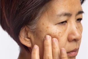 Tanpa kunyit, ini cara tuntaskan noda hitam agar wajah kembali bersinar pakai 1 jenis umbi-umbian