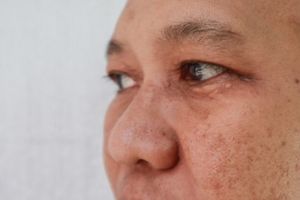 Tanpa air beras, ini cara hapus noda hitam akibat sering panas-panasan pakai 1 kulit buah