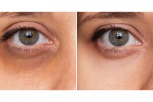 Tak pakai tambahan kopi, begini cara memutihkan kulit area bawah mata dengan 3 bahan dapur