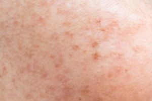 Trik atasi flek hitam di wajah pakai 1 jenis minuman, autoputih glowing dan bebas noda