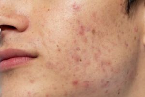 Pori-pori auto mengecil, ini cara hilangkan komedo dan jerawat pada wajah pakai 1 jenis buah-buahan