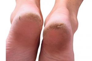 Tak perlu petroleum jelly, ini trik hilangkan tumit kaki pecah-pecah pakai 1 jenis lilin