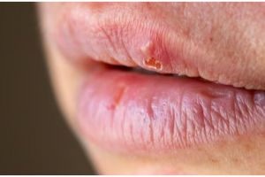 Bukan hanya bubuk kopi, ini cara atasi bibir kering dan retak pakai 1  bahan dapur