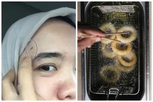 Trik mengatasi kulit wajah yang terciprat minyak panas supaya tak melepuh pakai 1 bahan dapur