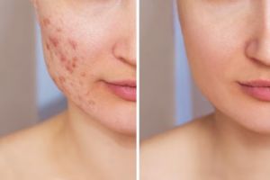Tak perlu aloe vera, ini trik muluskan kembali kulit rusak akibat breakout pakai 1 jenis buah