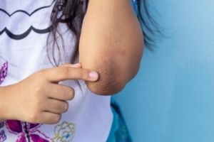 Tanpa butiran scrub kasar, ini cara bikin siku & lutut hitam kembali mulus cerah pakai 1 jenis minyak
