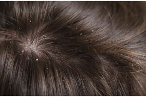 Bukan dioles jeruk nipis, ini cara hilangkan ketombe berkerak pakai hair oil dari 1 jenis daun