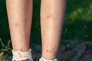 Tanpa lemon, ini cara memudarkan flek hitam di kaki akibat bekas gigitan serangga pakai 1 bahan dapur