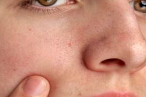 Tak perlu tambahan putih telur, ini cara samarkan ukuran pori wajah pakai 1 jenis tumbuhan herbal